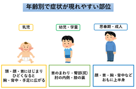 アトピー性皮膚炎