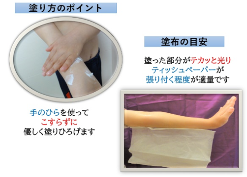 アトピー性皮膚炎