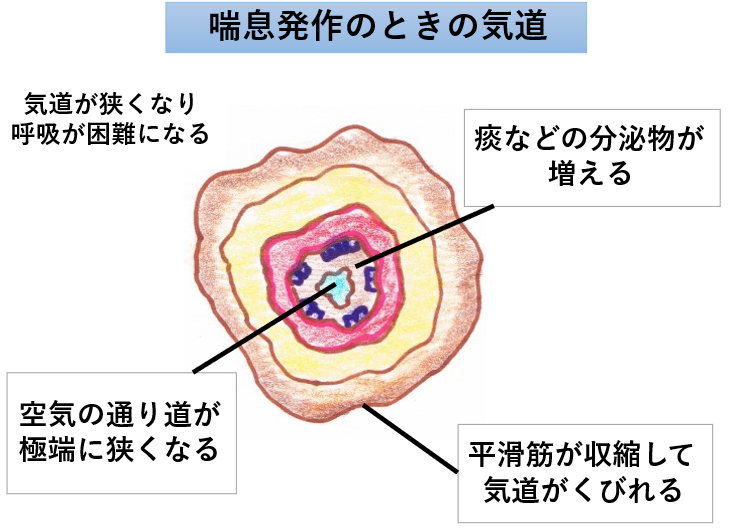 気管支喘息