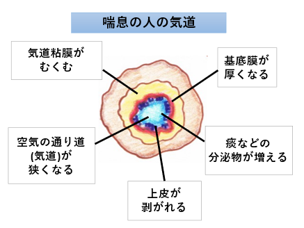 気管支喘息